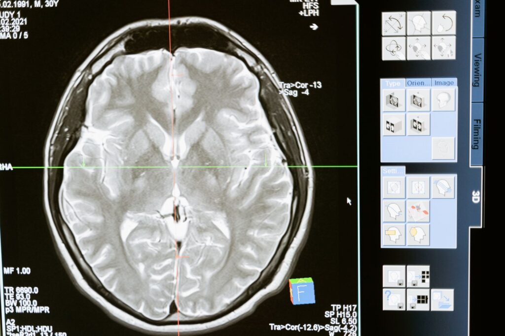 An MRI brain scan displayed on a screen for analysis