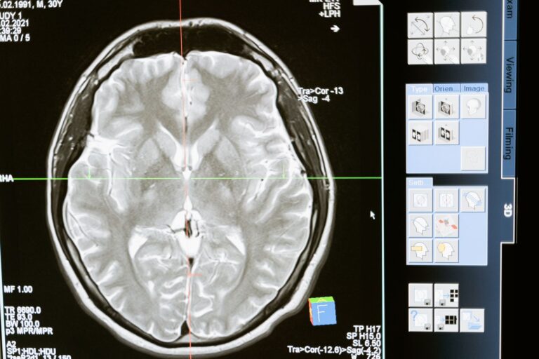 An MRI brain scan displayed on a screen for analysis
