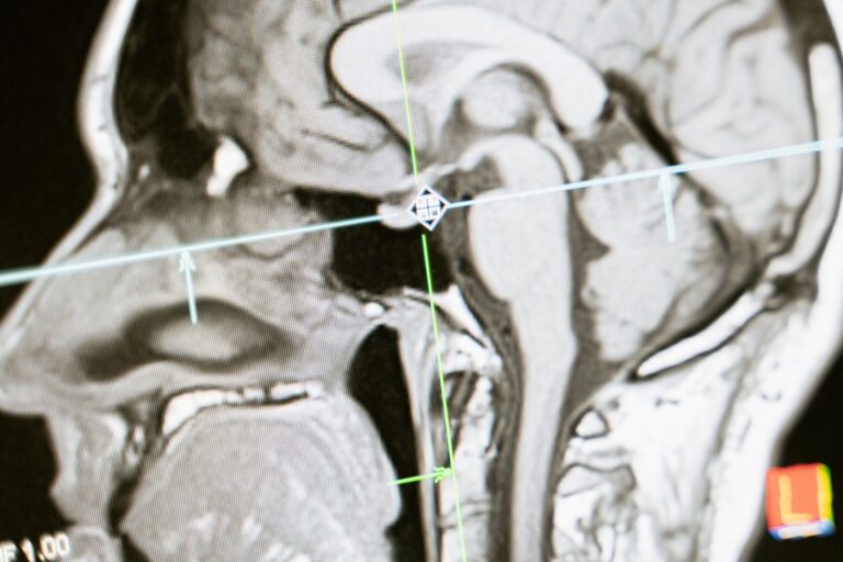 An MRI scan showing a sagittal view of the brain